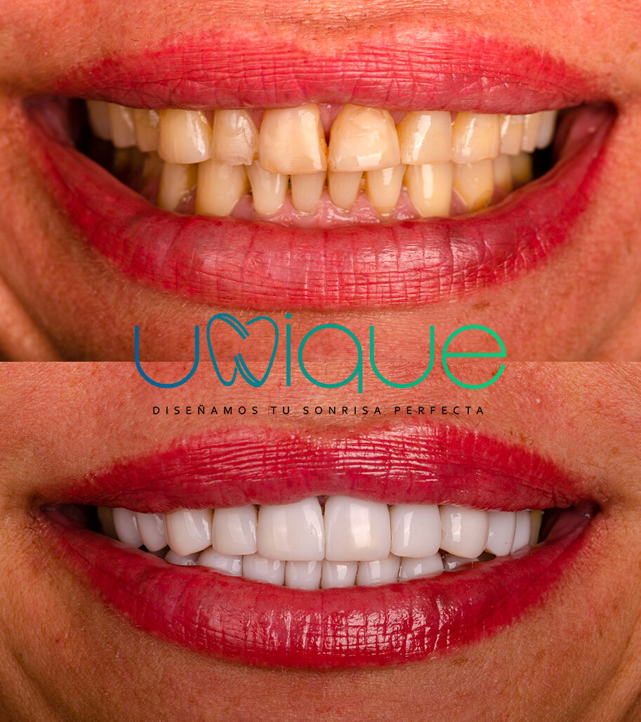 Composite veneer transformation — Brenda