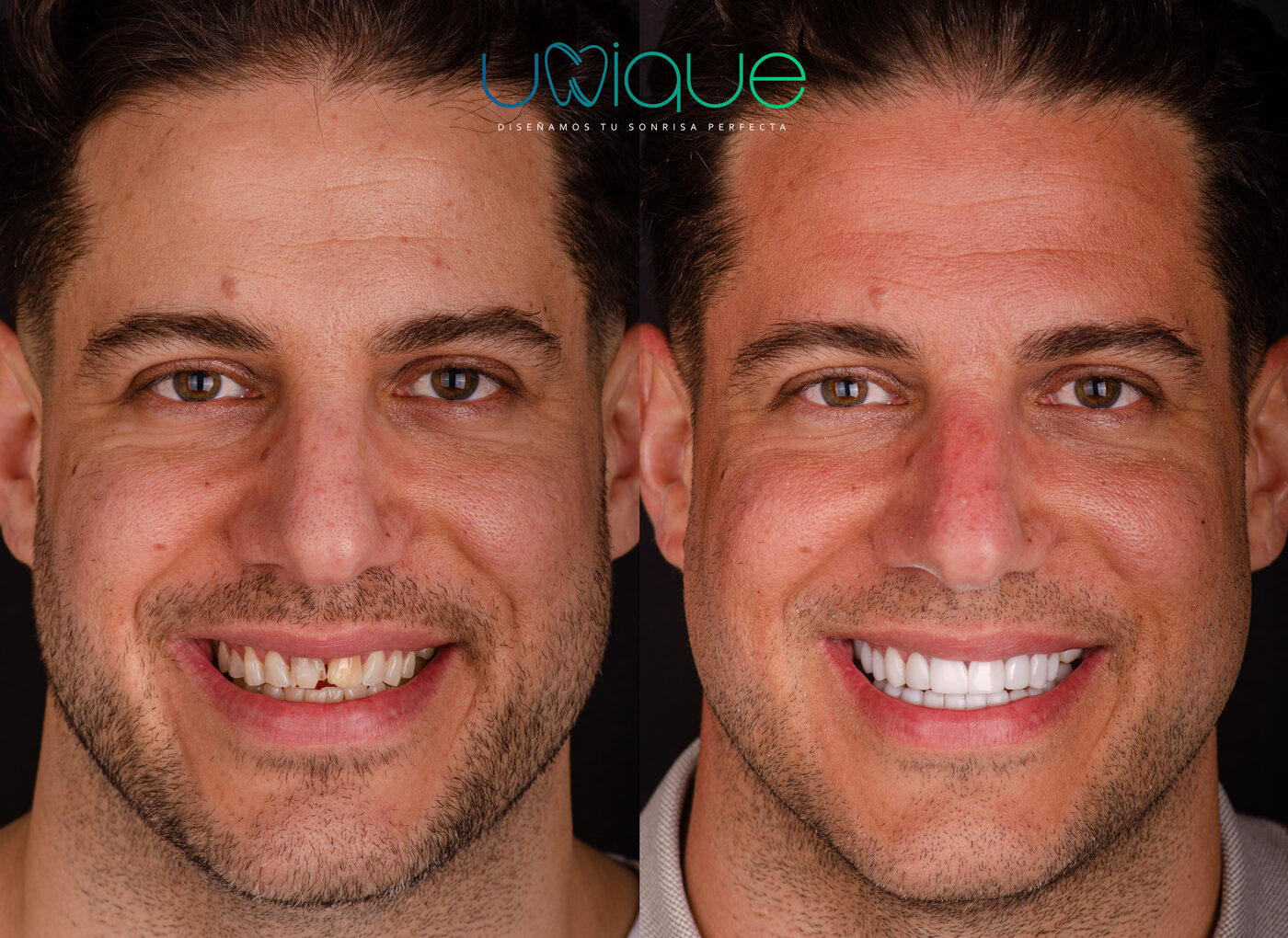 Composite veneer transformation — Alexander