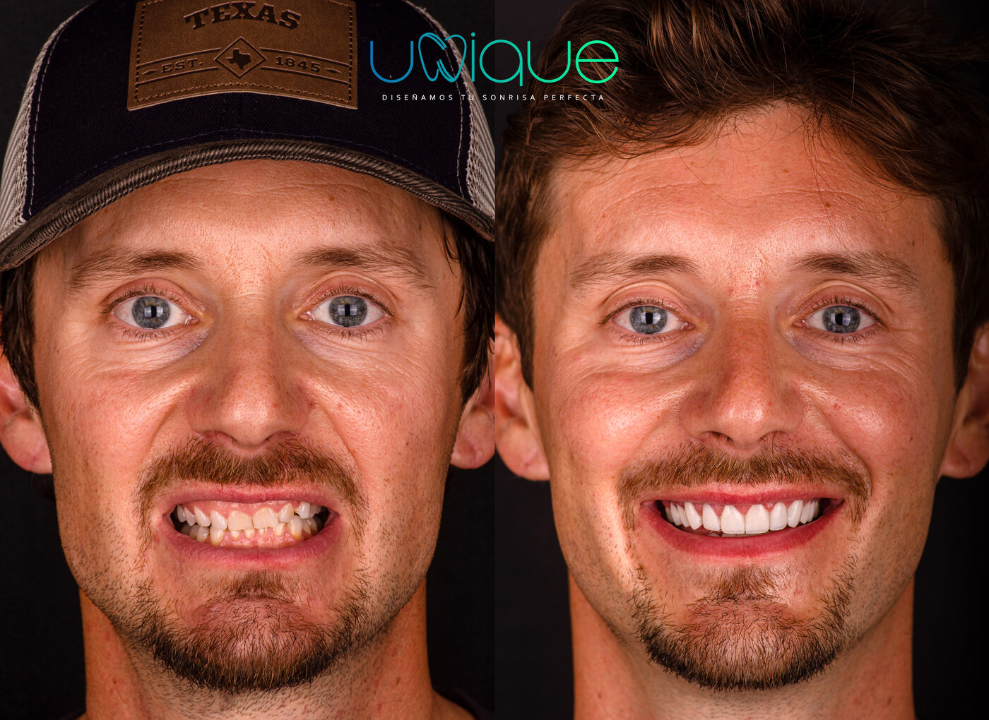 Porcelain veneer transformation — Daniel