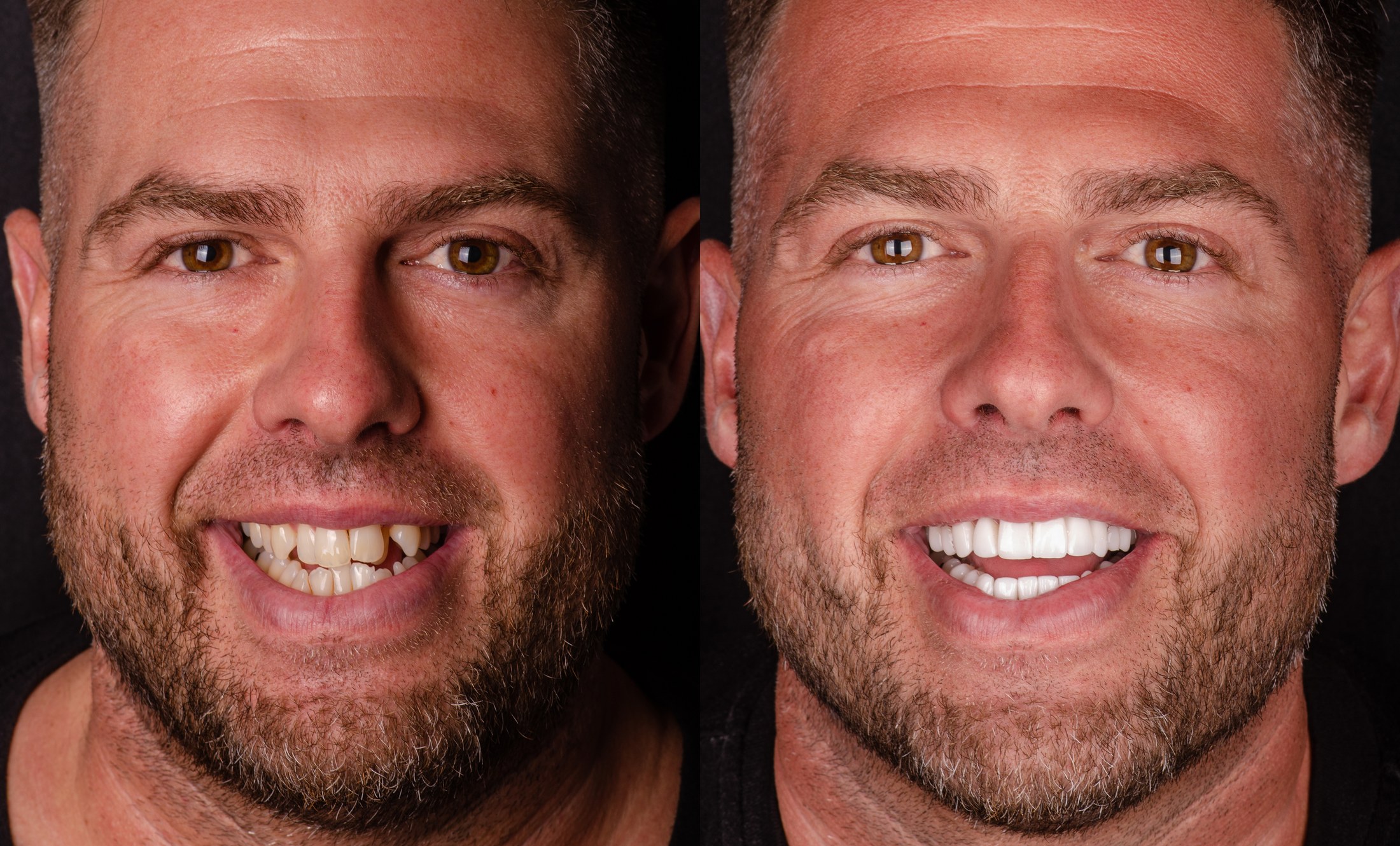 Patient before and after porcelain veneer treatment in Cancun