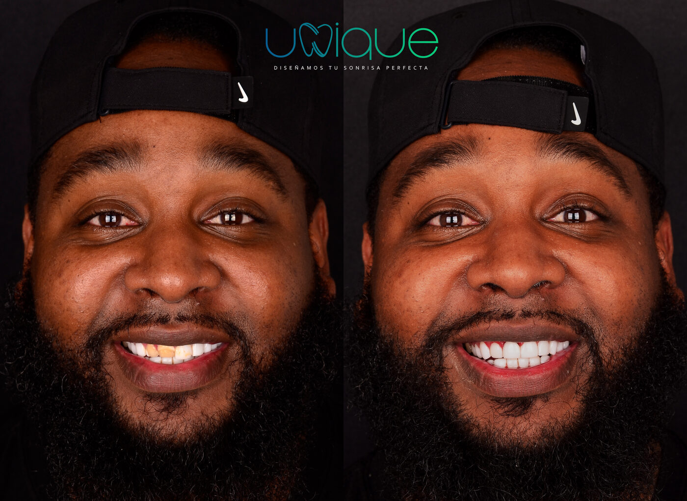 Porcelain veneer transformation